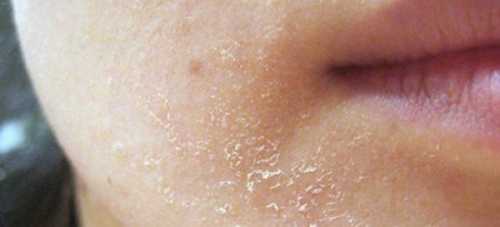 Чому лущиться шкіра на обличчі і як це виправити - INFBusiness