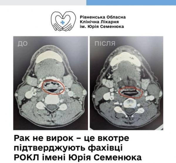 Рівненські лікарі розповіли про порятунок чоловіка з раком гортані - INFBusiness