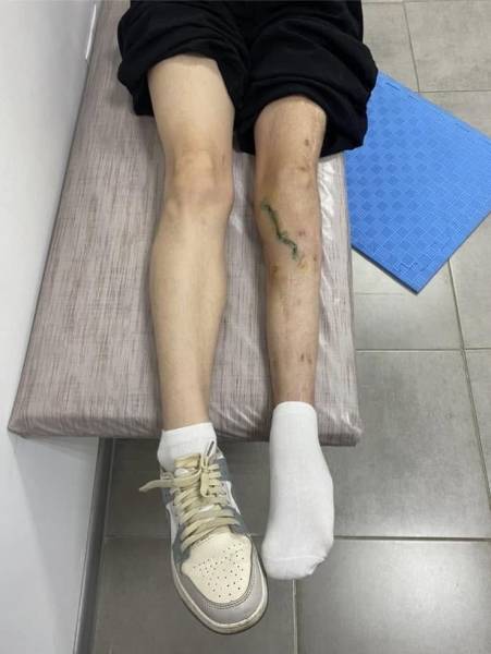 "Поставили на ного за чотири місяці": лікарі Рівненської обласної дитячої лікарні провели операції для 17-річної Ангеліни - INFBusiness